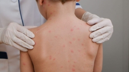 Vacinação contra a meningite termina no próximo dia 31 de julho 