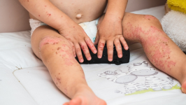 Alerta sobre a Doença Mão-Pé-Boca: Prevenção e Cuidados Essenciais
